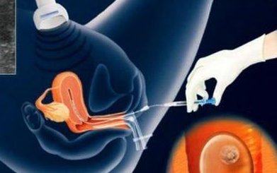 膝胸卧位做4天纠正胎位，臀位就直接变横位了是真的吗？